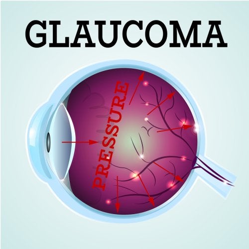 Glaucoma Treatment at Gerstein Eye Institute